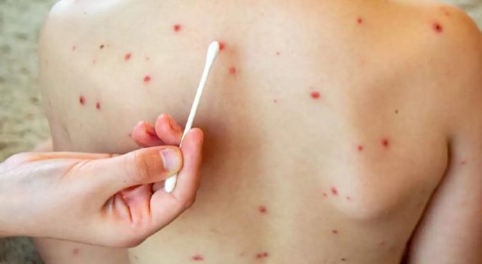 Aumentan a 13 los muertos por sarampión en el estado