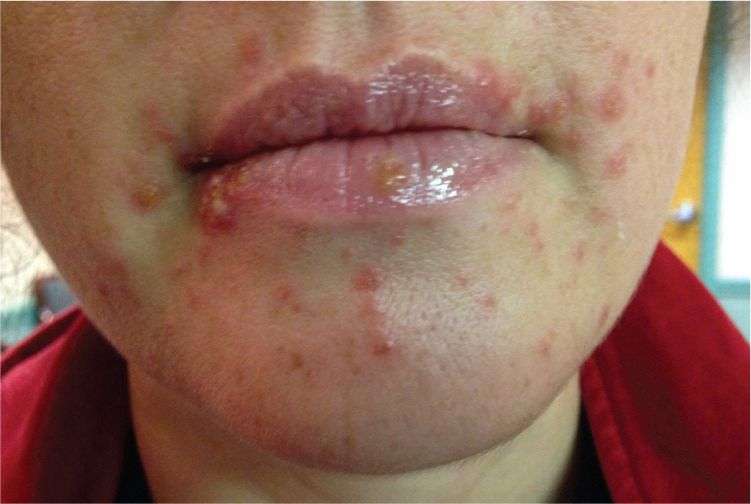 Registran aquí 12 brotes y 134 contagios de virus Coxsackie