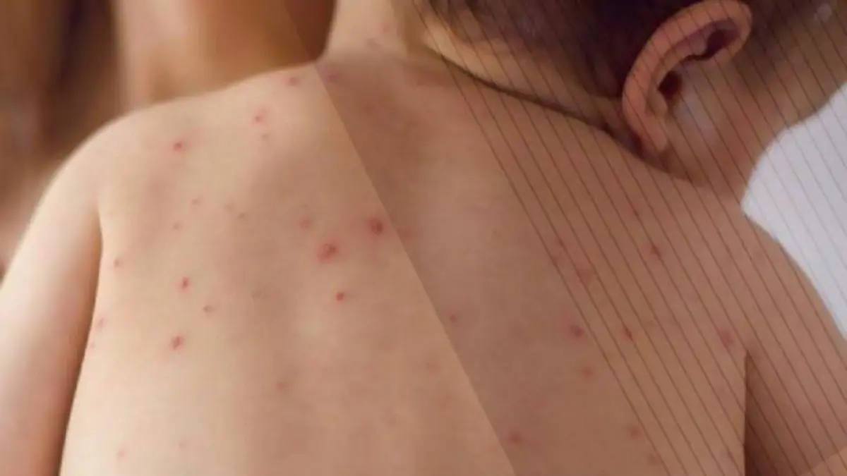 Confirman muerte número 21 por sarampión en el estado de Chihuahua