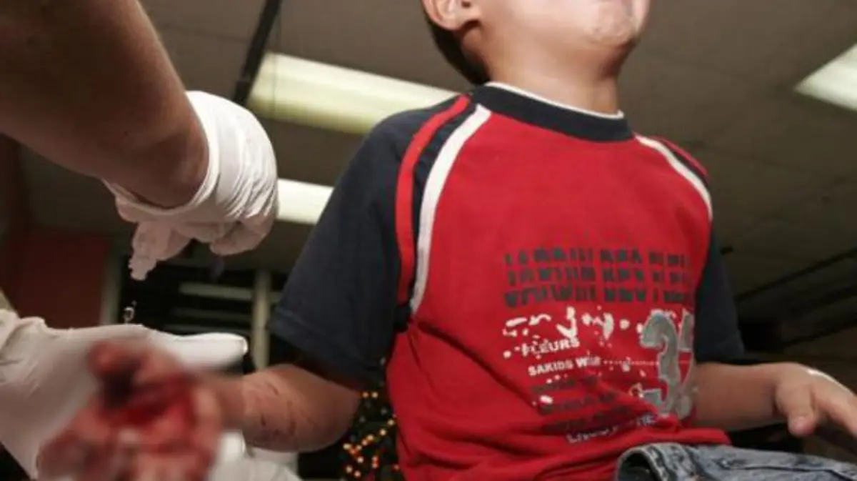 Otro más… Pirotecnia causó quemaduras graves a menor en Julimes