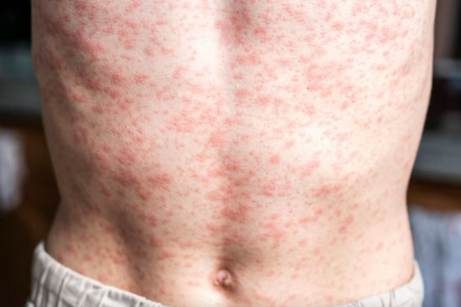 Muere lactante por complicaciones de sarampión en Tlaxcala